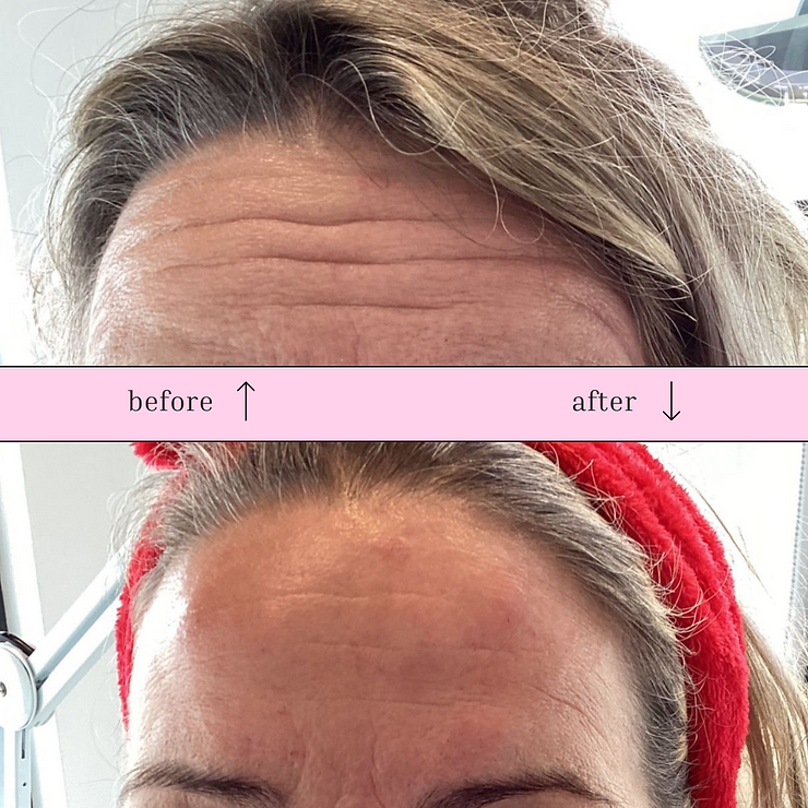 Before & After botox behandeling voorhoofd